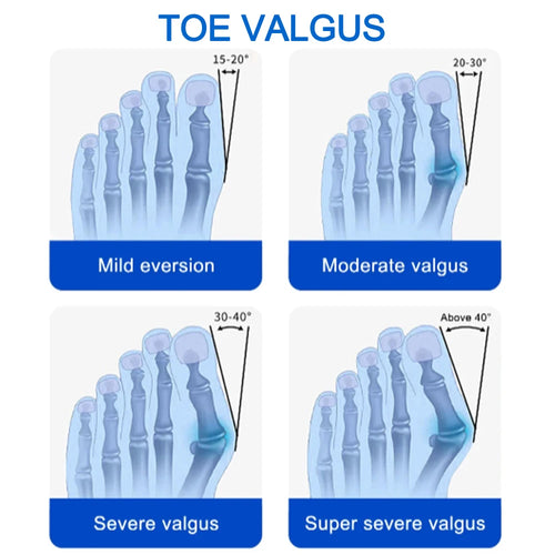 Bunion Splint Big Toe Straightener Hallux Valgus Correction Orthotic for Foot Bone Alignment and Bunions Relief